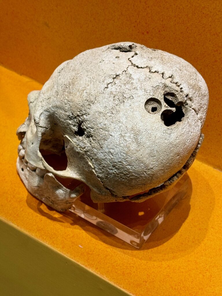 Early cranial surgery skull Monte Albán